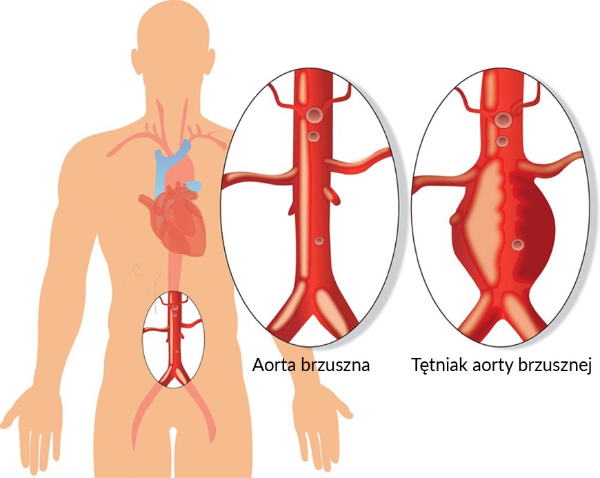 Grafika ludzkiej sylwetki w przekroju pokazującym aortę